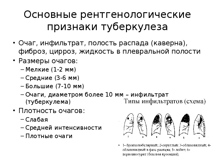 Туберкулез легких карта вызова