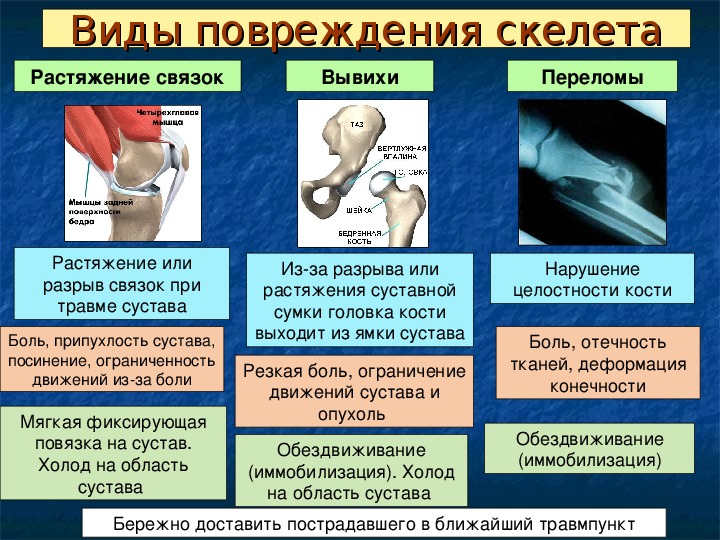 Первая помощь при травмах растяжении связок вывихах суставов переломах костей 8 класс презентация