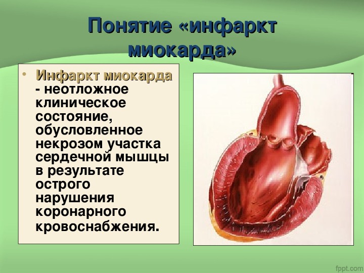 Сестринская помощь при инфаркте миокарда презентация