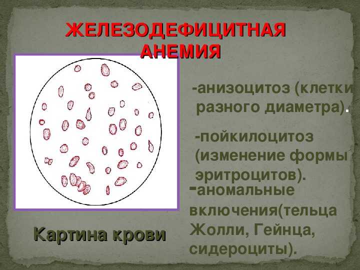Пойкилоцитоз анемия. Анизоцитоз анемия. Железодефицитная анемия анизоцитоз. Пойкилоцитоз анизоцитоз анемия. Железодефицитная анемия пойкилоцитоз.