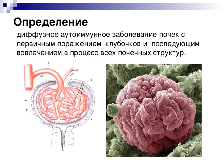 Острый гломерулонефрит картинки