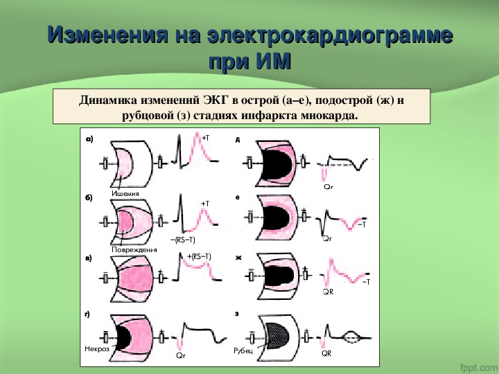 Изменения миокарда на экг. Рубцовая стадия инфаркта миокарда на ЭКГ. Рубцовые изменения на ЭКГ. Изменения на ЭКГ после инфаркта. Рубцовые изменения на ЭКГ после инфаркта.