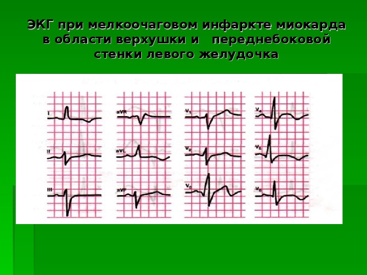 Презентация экг при инфаркте миокарда