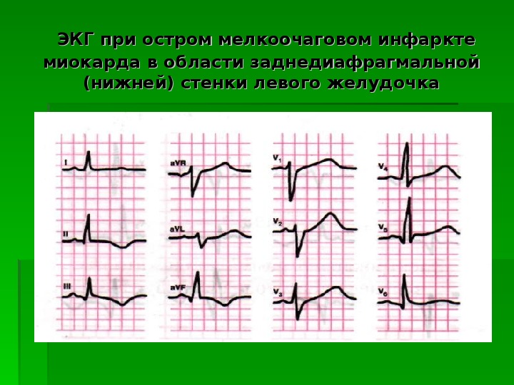 Как выглядит инфаркт на экг картинки и фото