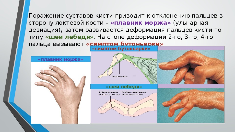 Ревматоидный артрит суставов кистей. Шея лебедя ревматоидный артрит. Деформация кисти при ревматоидном артрите. Деформации суставов пальцев ревматоидный артрит. Деформация суставов при ревматоидном артрите.