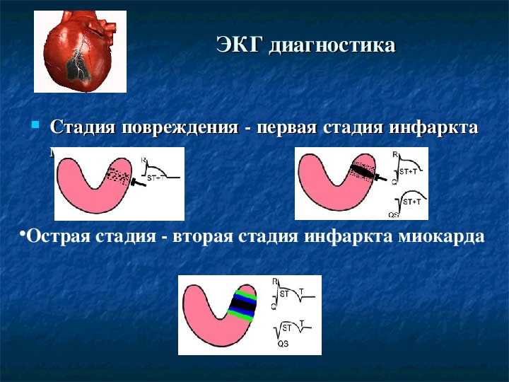 Презентация сестринская помощь при инфаркте миокарда