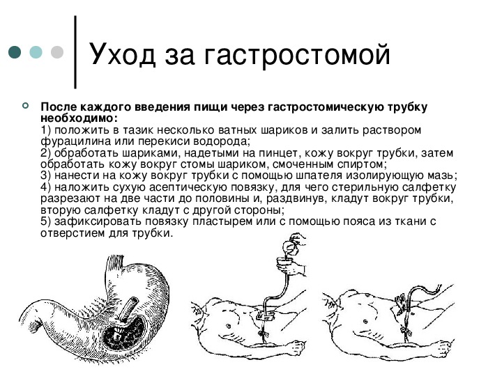 Назогастральный зонд и гастростома: аспекты ухода и решение проблем +аудио