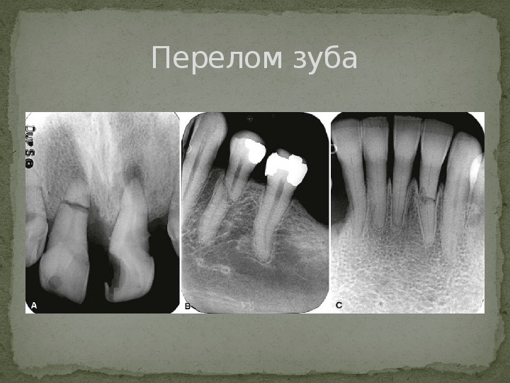 Сестринский уход при травмах челюстно-лицевой области