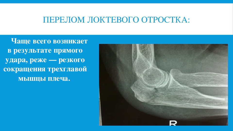 Перелом локтя. Краевой перелом венечного отростка локтевой. Перелом локтевого отростка рентген заключение.