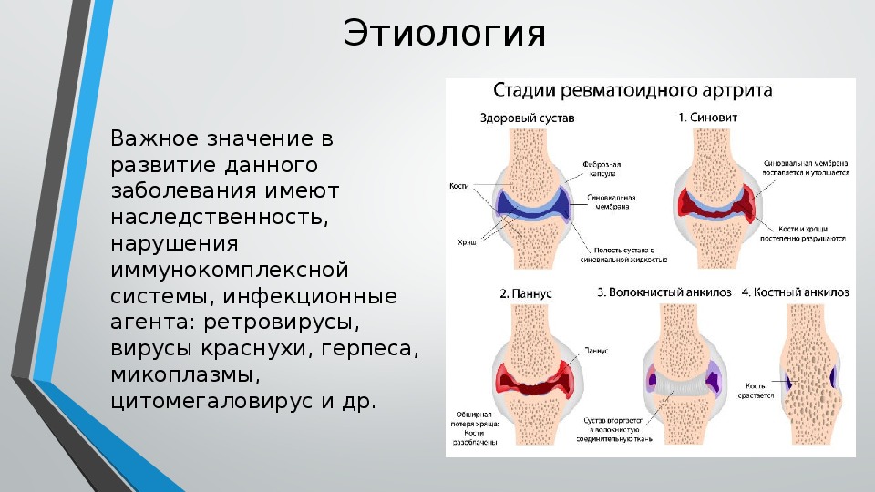 Ревматоидный артрит схема