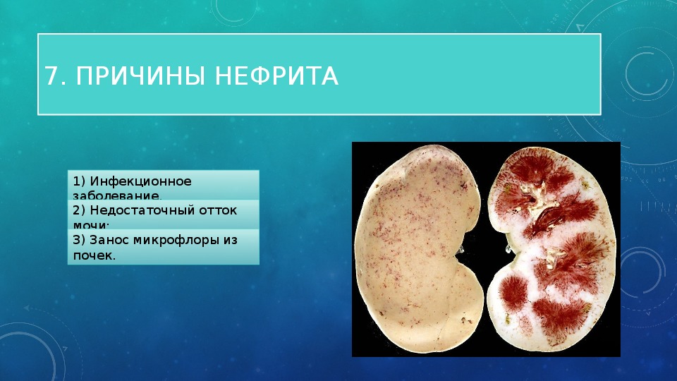 Хронический нефрит. Нефрит заболевание почек. Нефрит заболевание мочевыделительной системы.