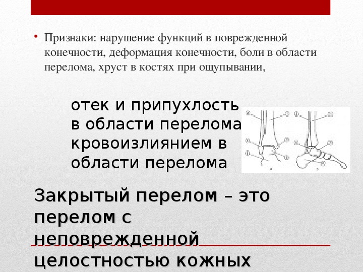 Переломы обж 7 класс презентация