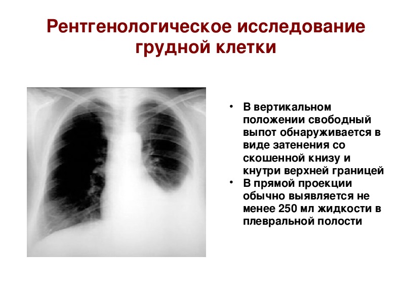 Экссудативный плеврит рентгенологическая картина