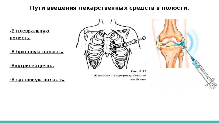 Способы введения лекарственных средств. Пути введения лекарственных средств в полости. Введение лекарств в плевральную полость.